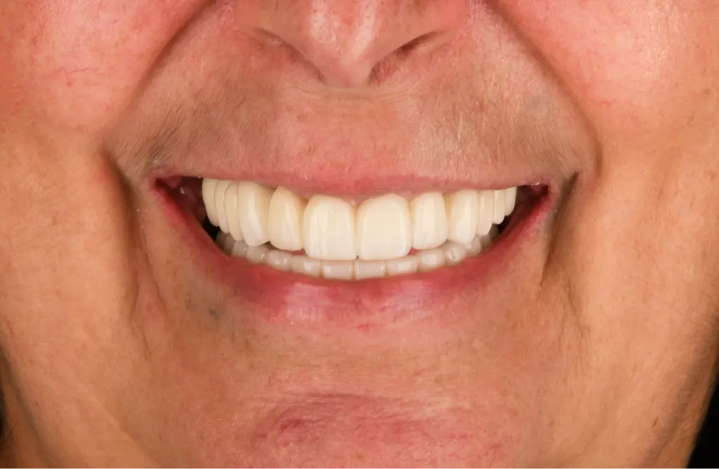 Smile close-up after treatment