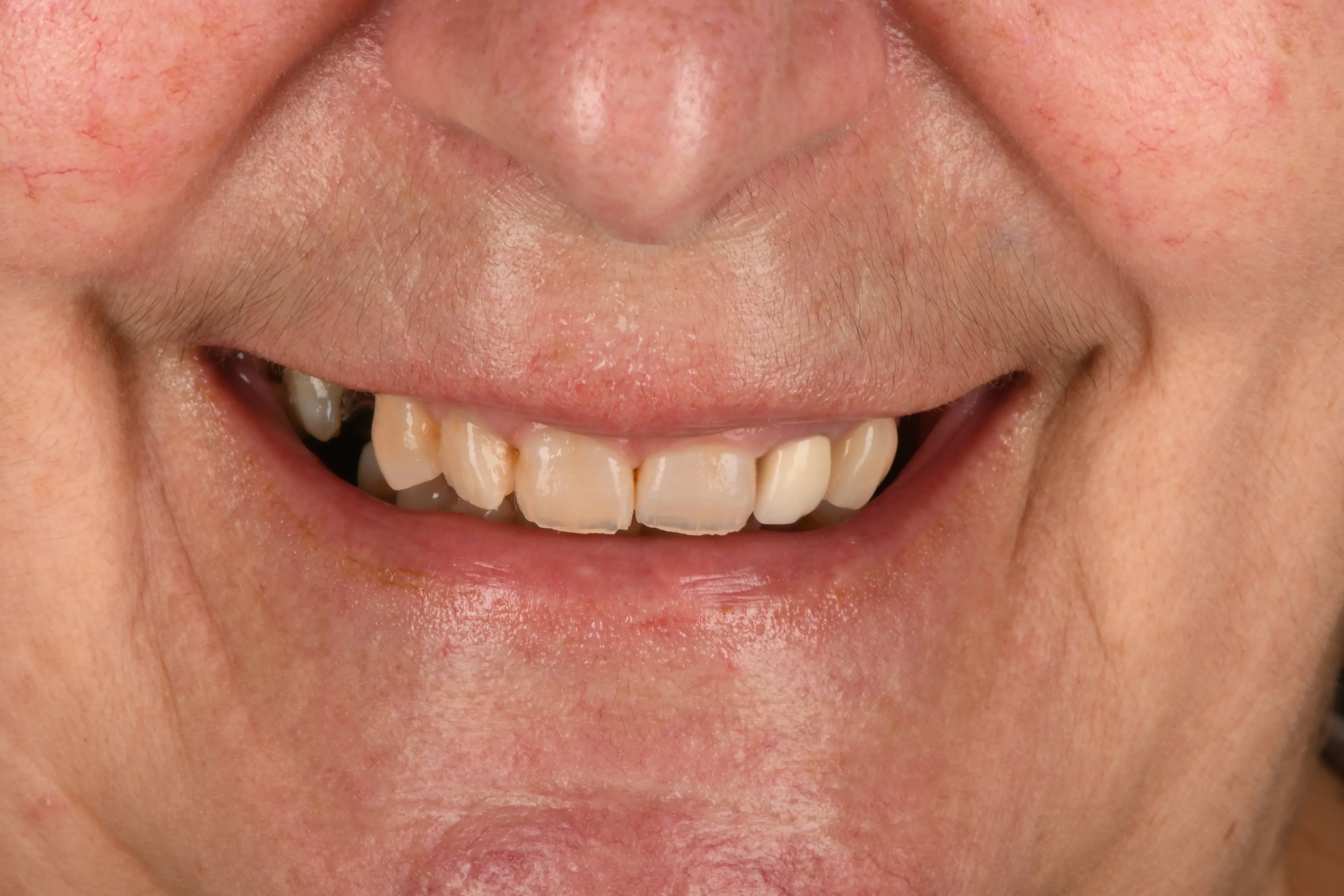 Smile close-up before treatment