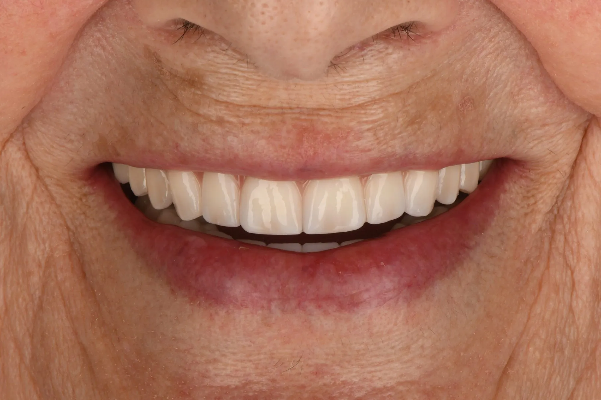Smile close-up after treatment