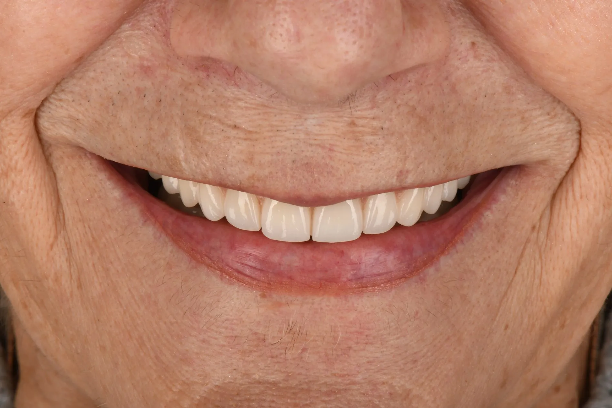 Smile close-up after treatment