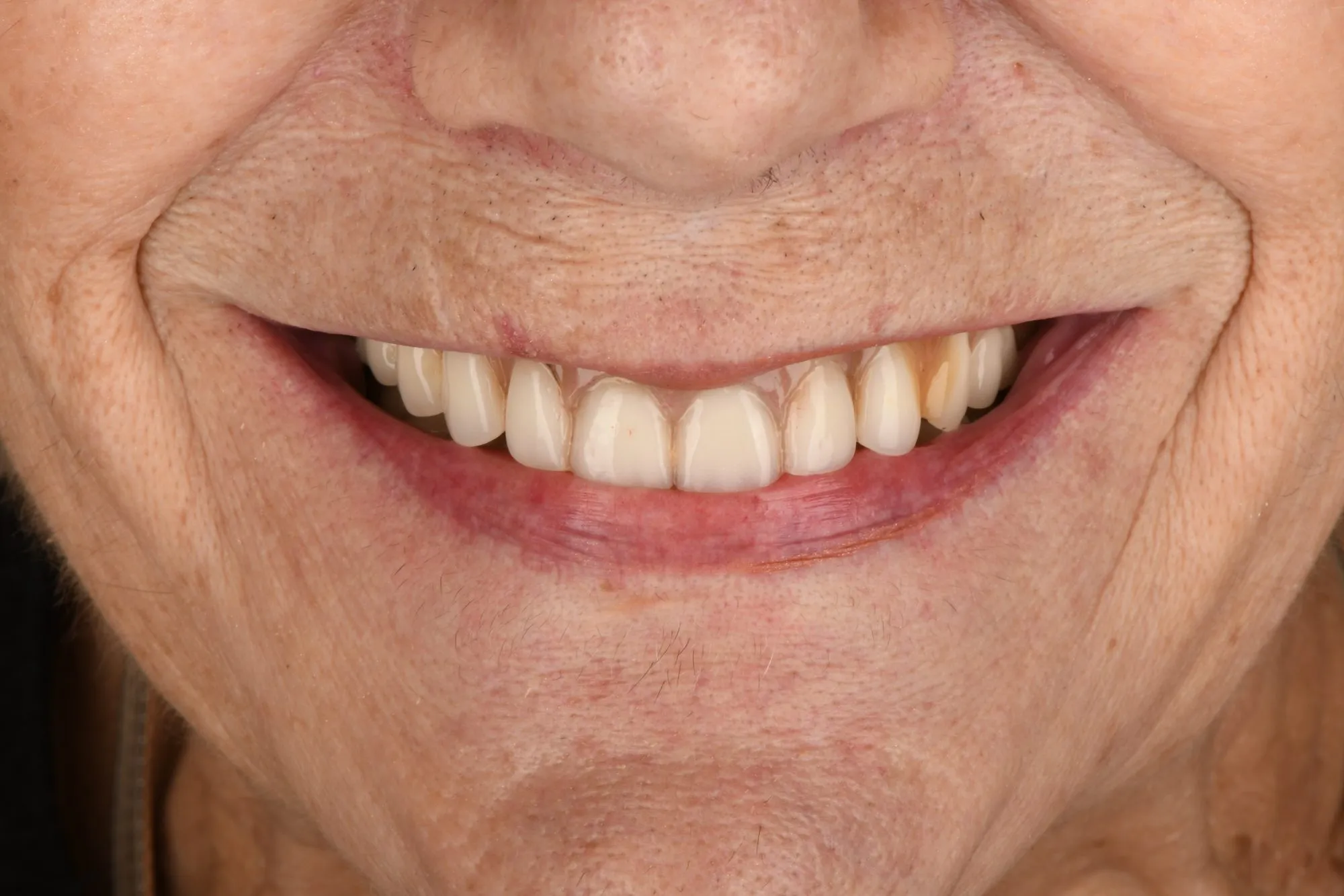 Smile close-up before treatment