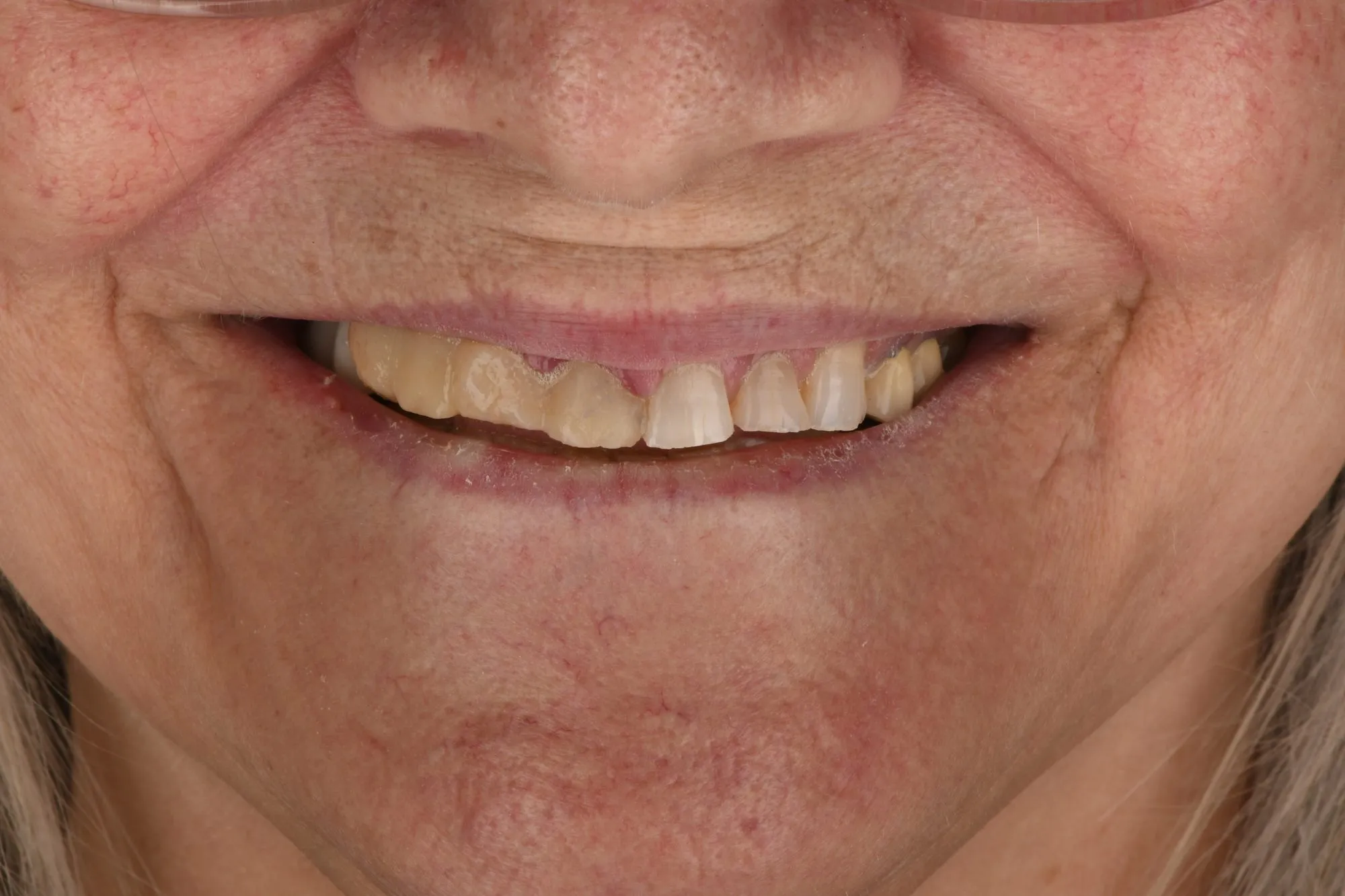Smile close-up before treatment