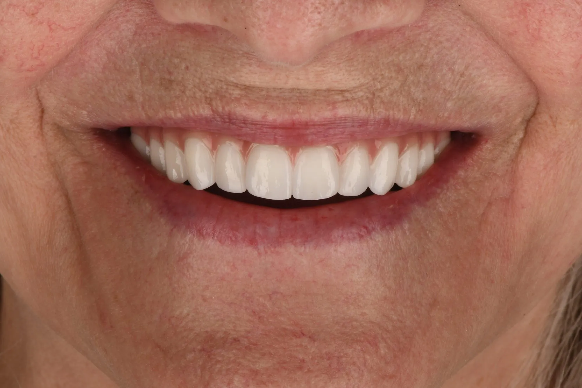 Smile close-up after treatment