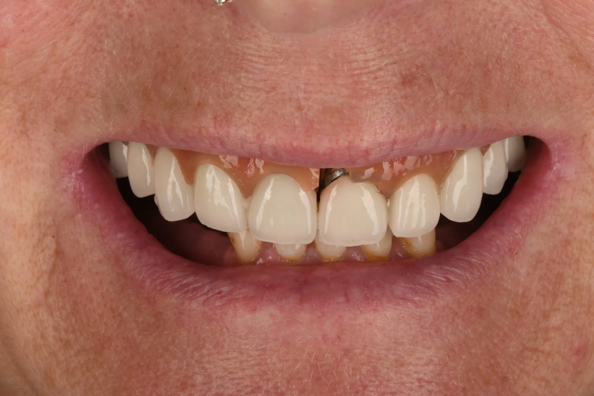 Smile close-up before treatment