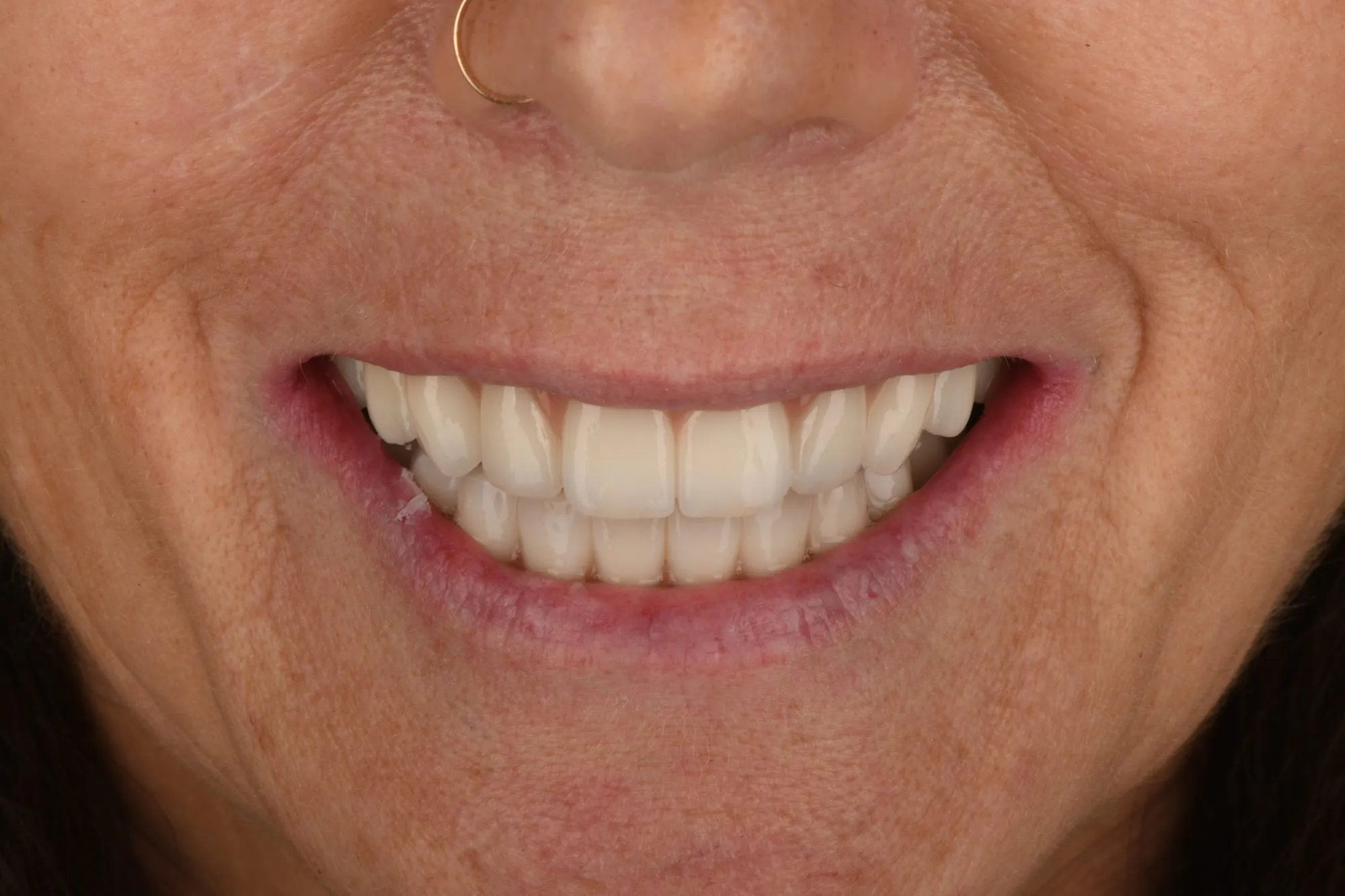 Smile close-up after treatment