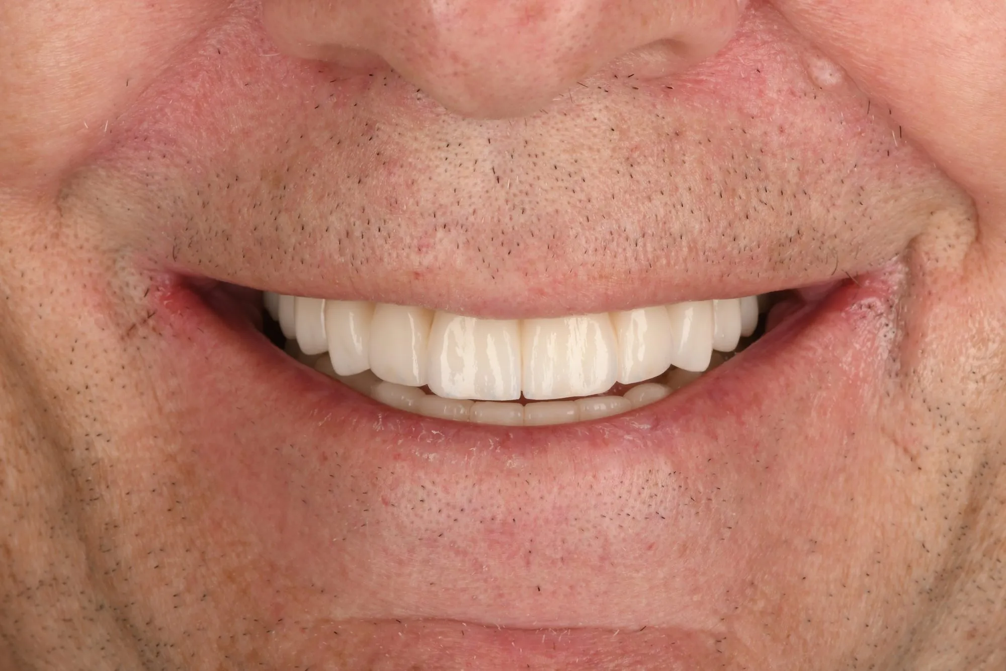 Smile close-up after treatment
