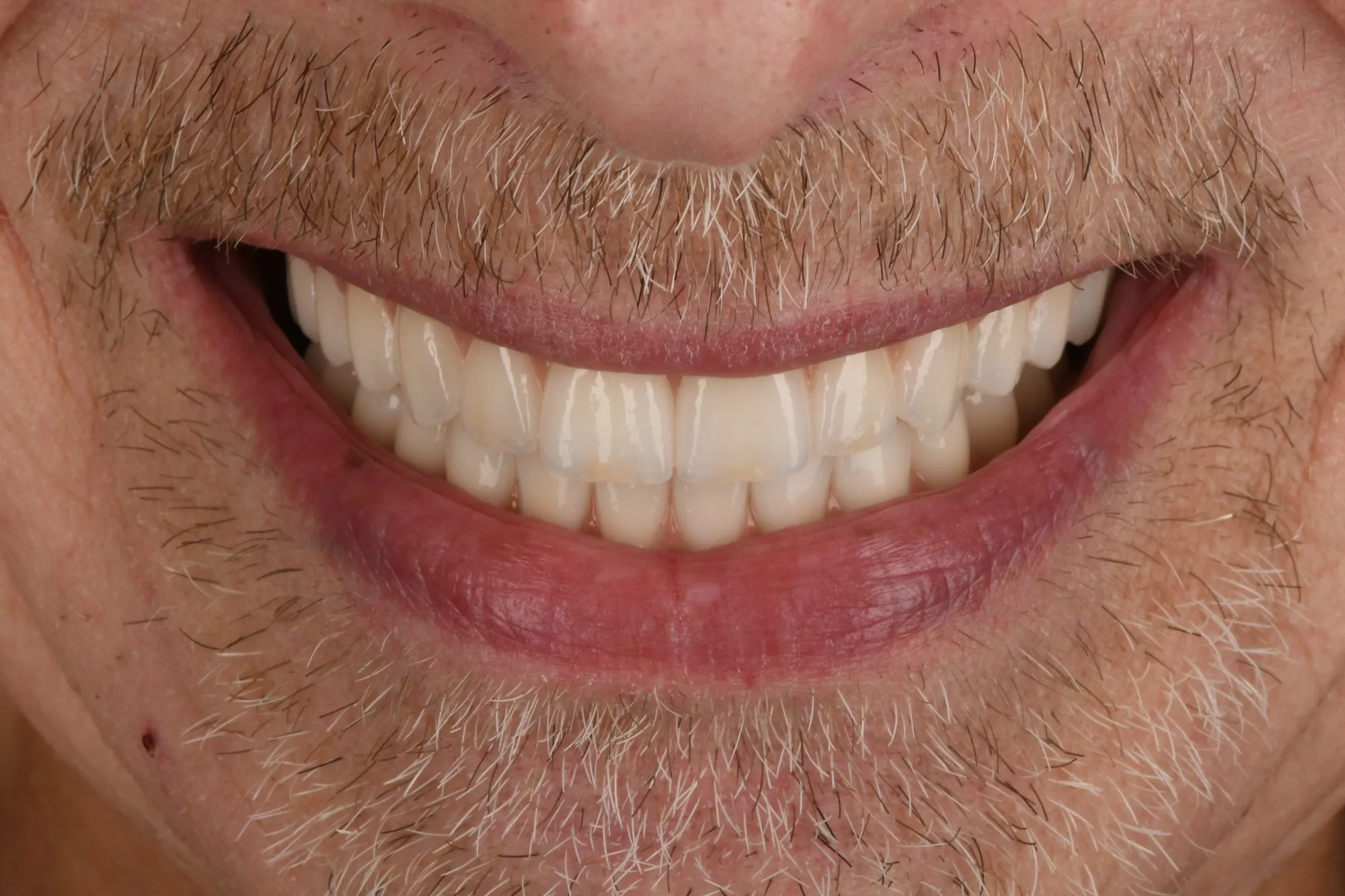 Smile close-up after treatment