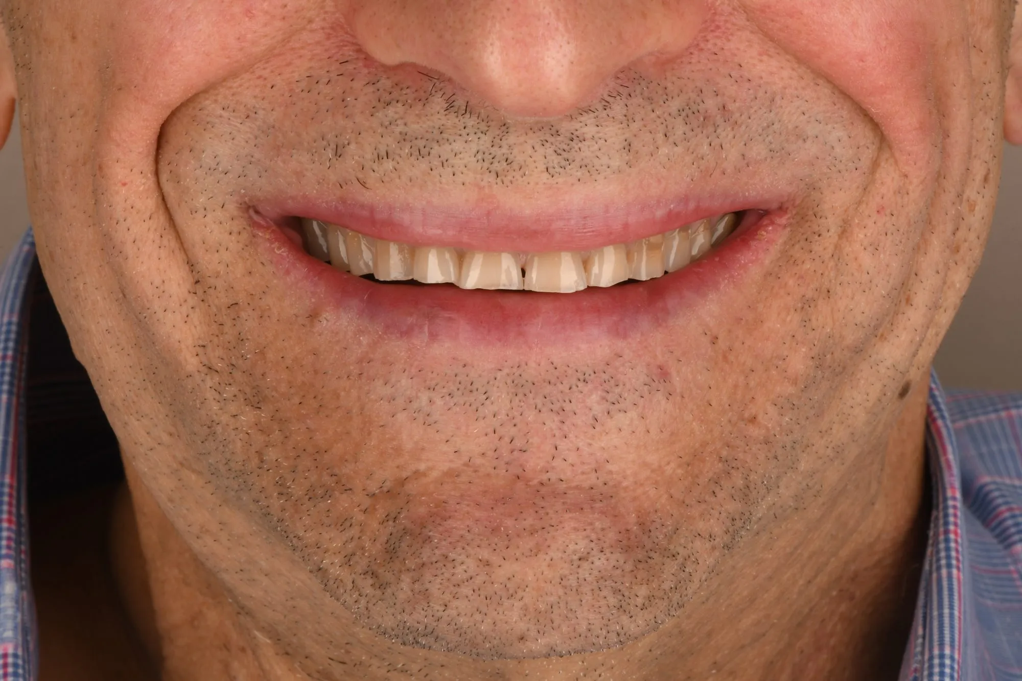 Smile close-up before treatment