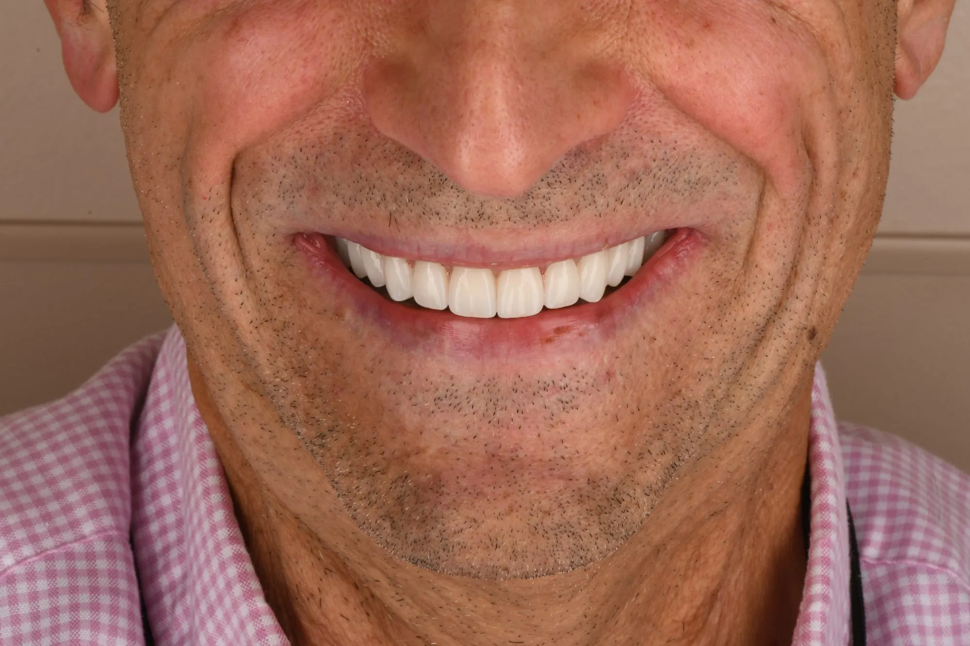 Smile close-up after treatment