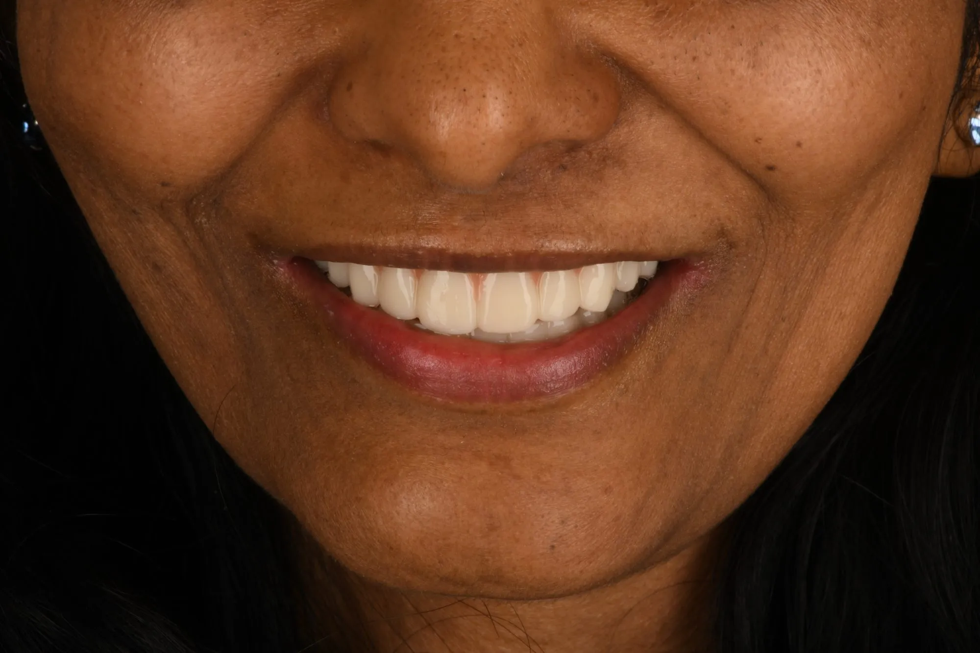 Smile close-up after treatment