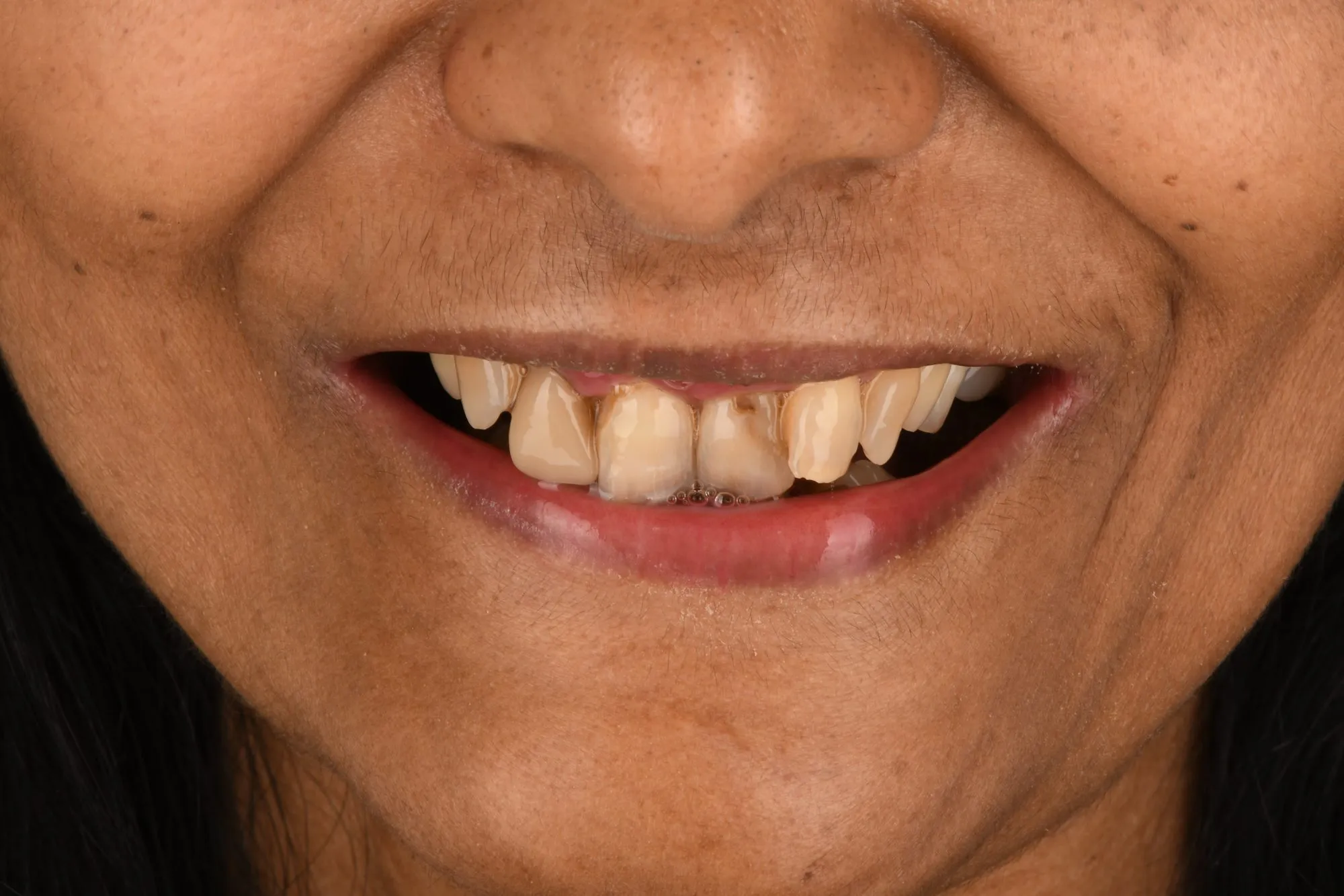 Smile close-up before treatment