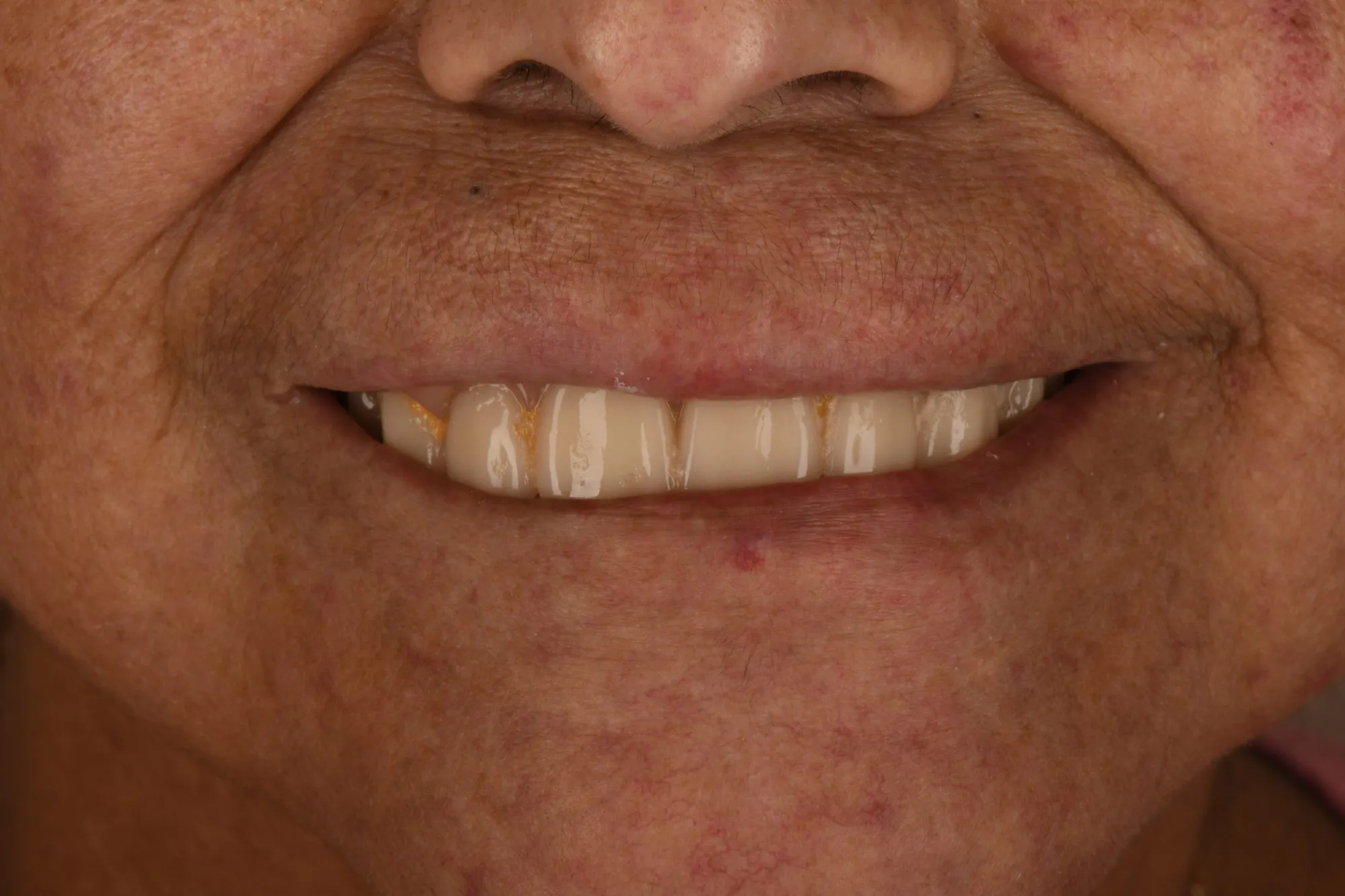 Smile close-up before treatment
