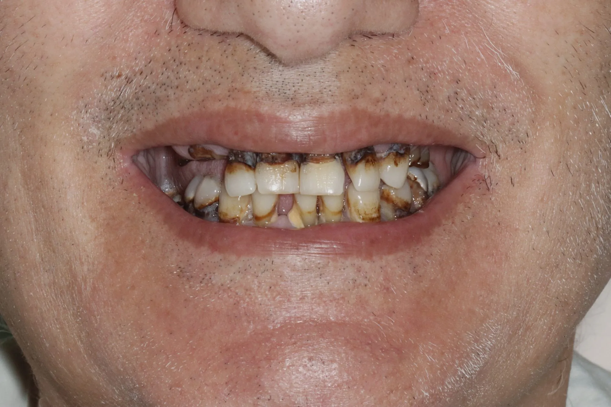 Smile close-up before treatment