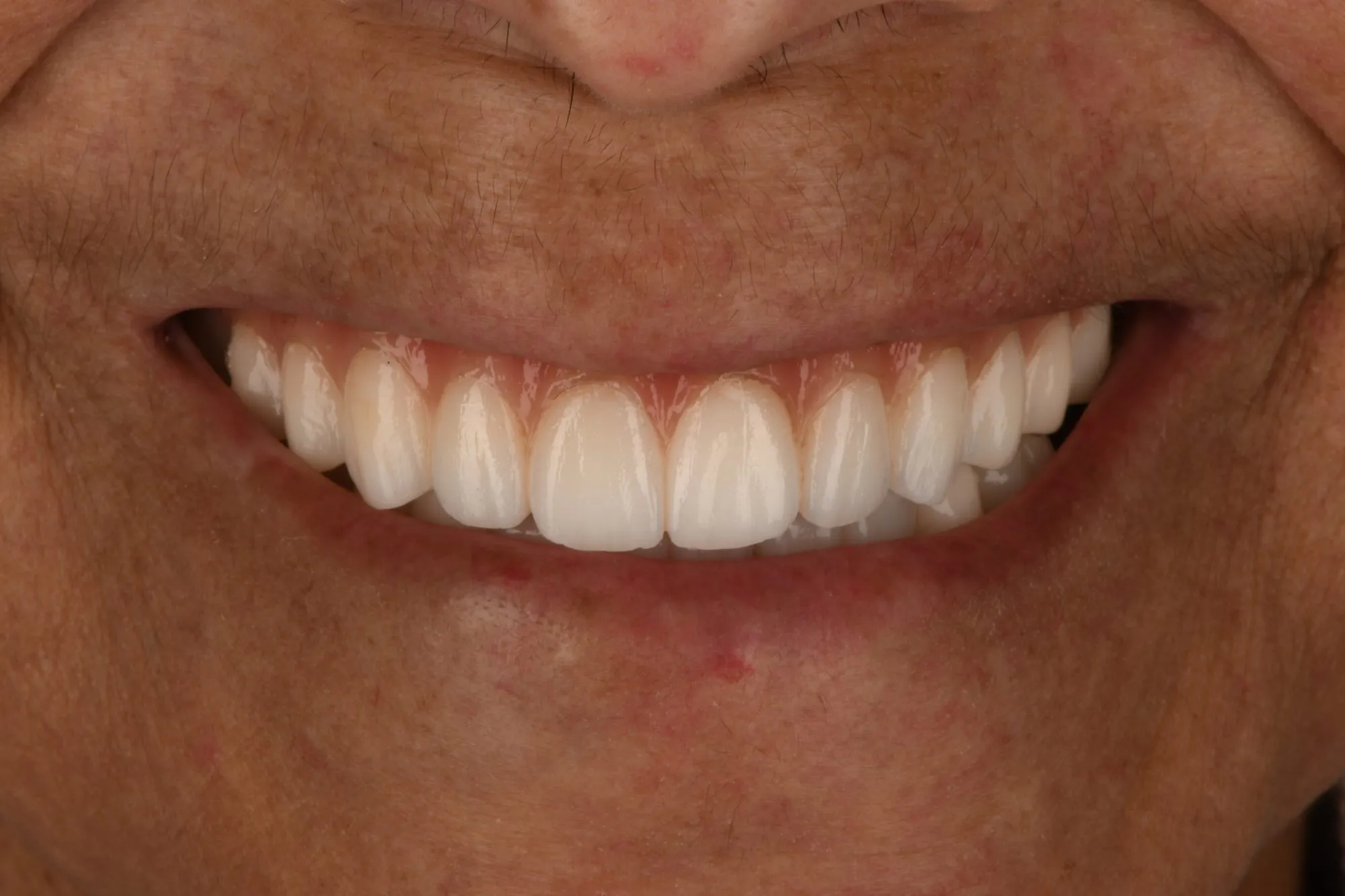 Smile close-up after treatment