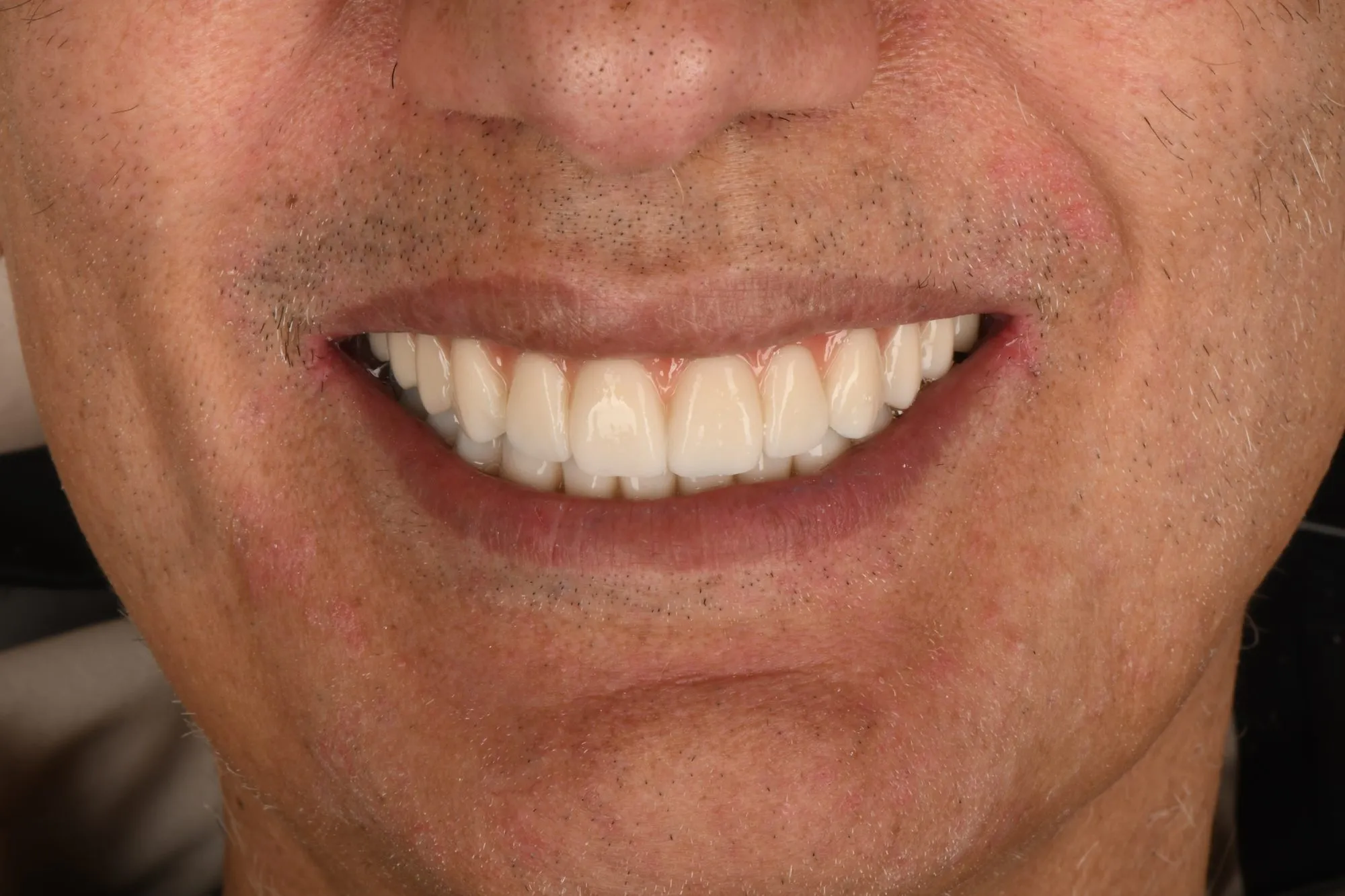 Smile close-up after treatment