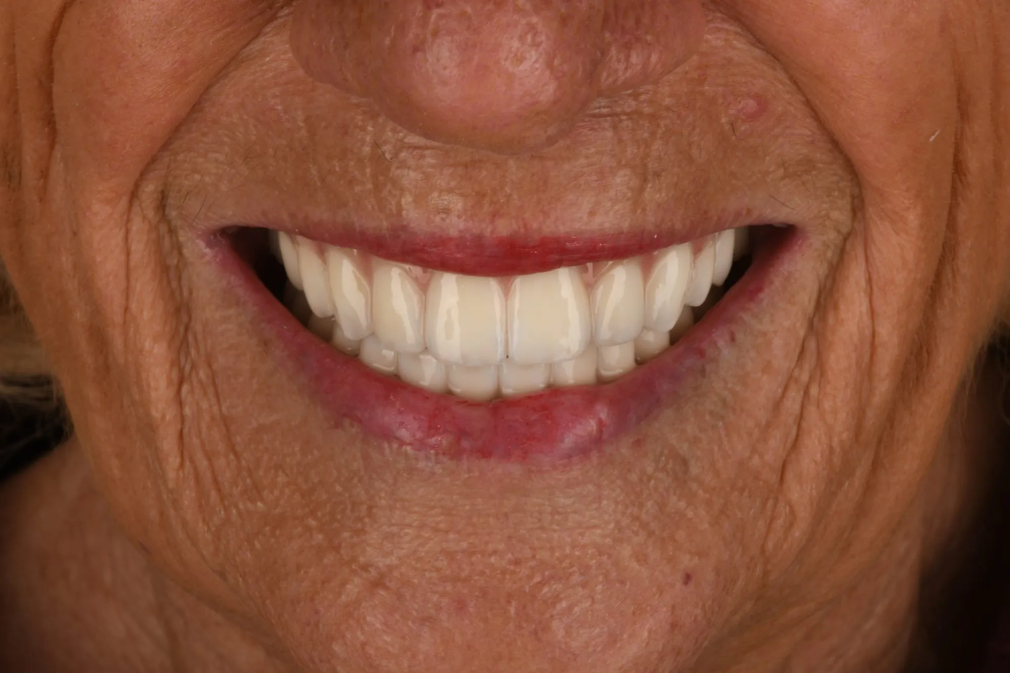 Smile close-up after treatment
