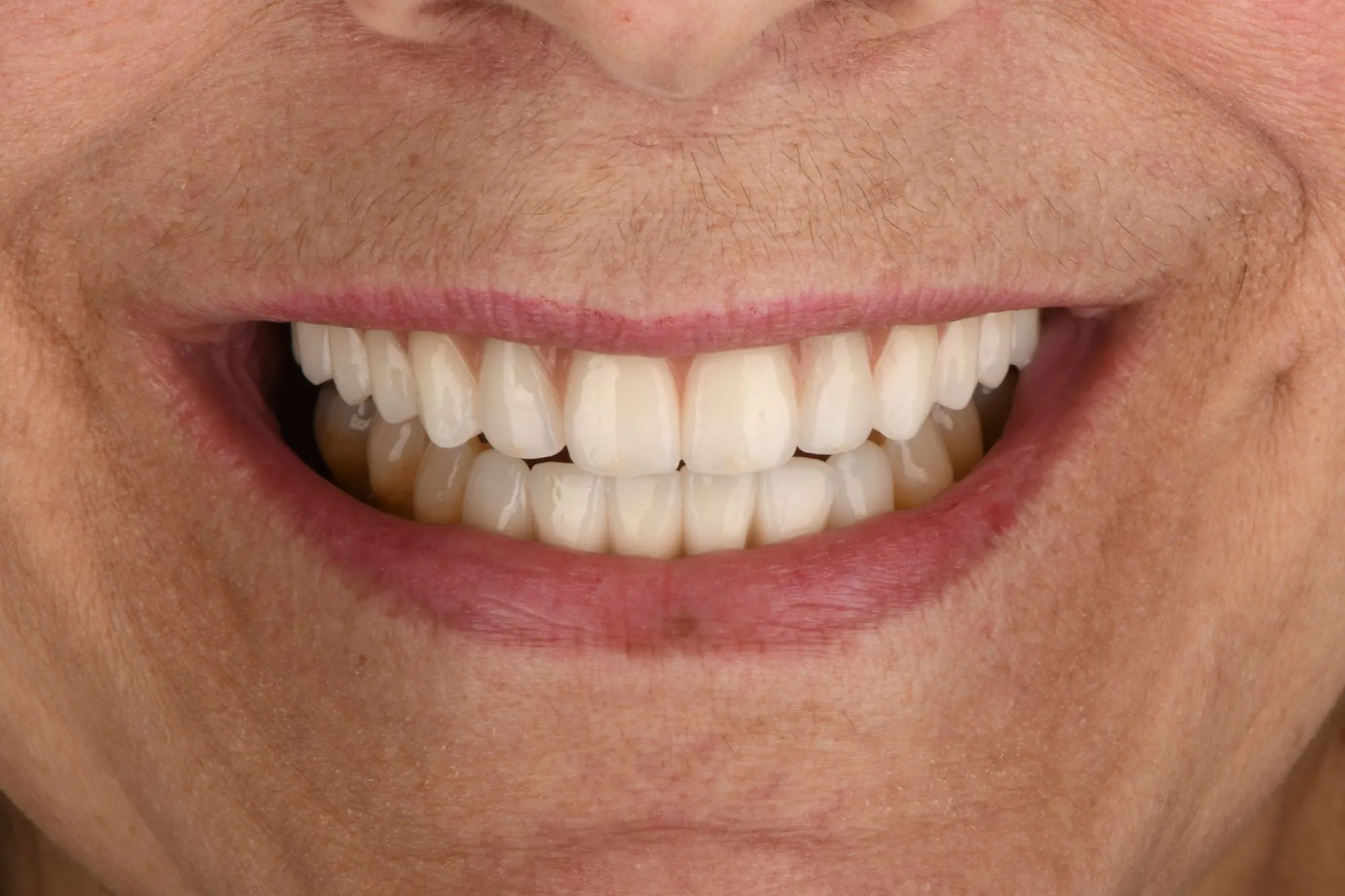 Smile close-up after treatment
