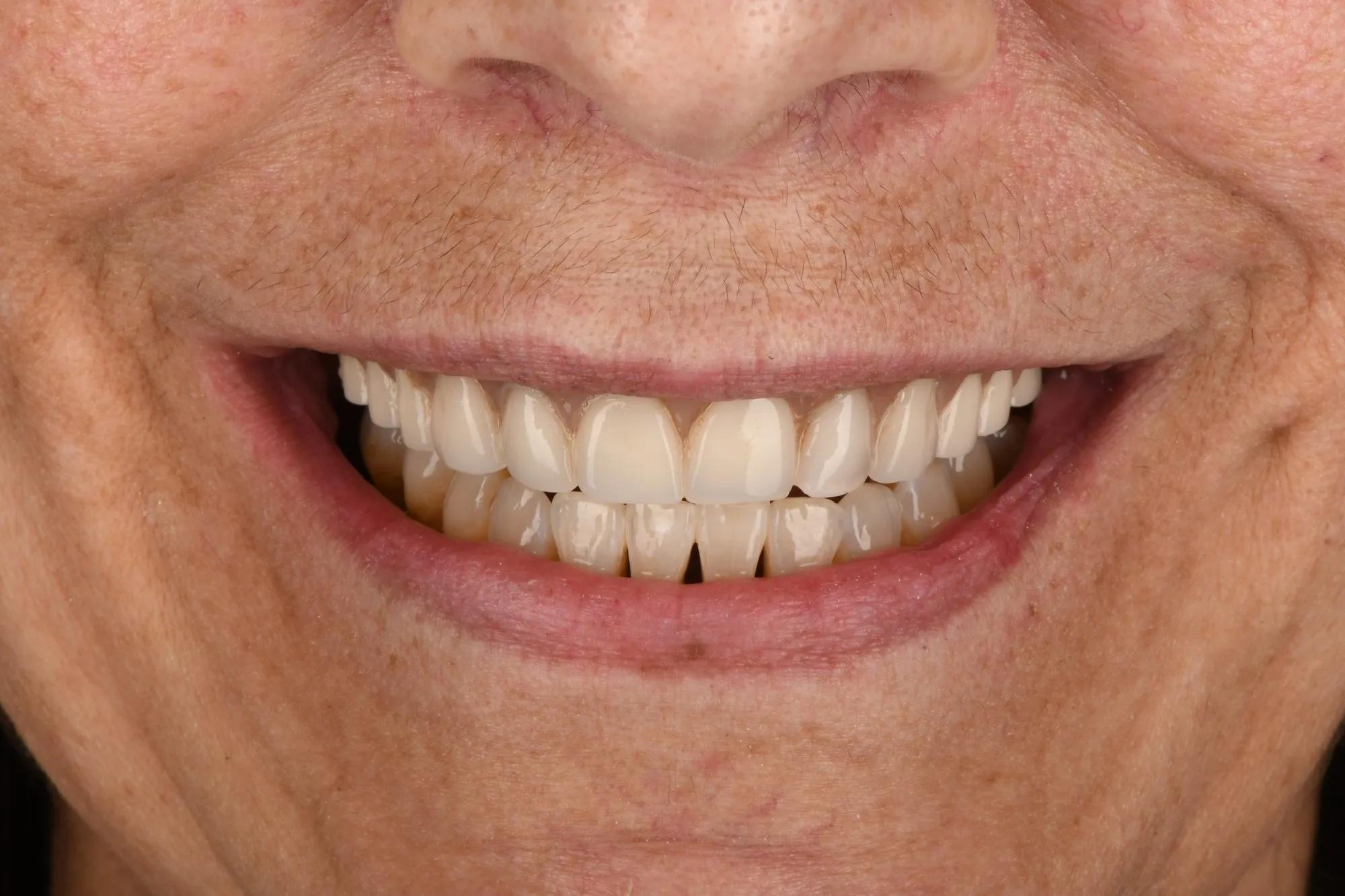 Smile close-up before treatment