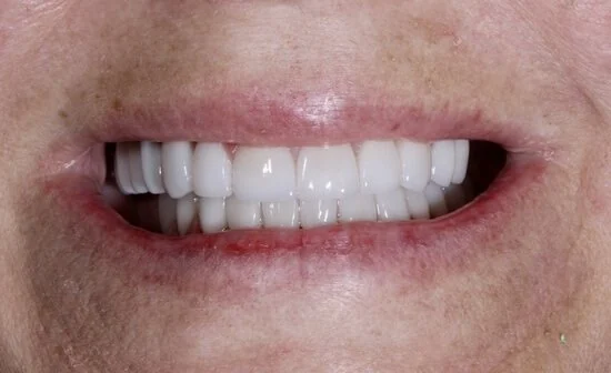 Smile Makeover