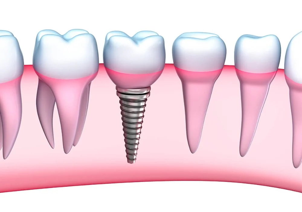 What Happens During the Dental Implant Process?