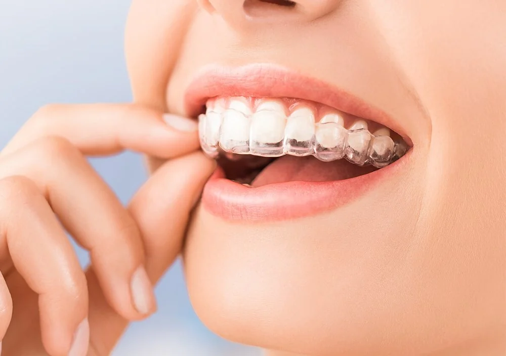 Clear Aligners or Braces: Which One Fits Your Life?