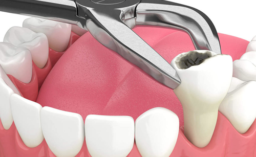 Tooth Extractions