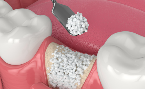 Bone Grafting