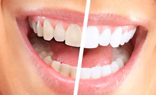 Teeth Whitening