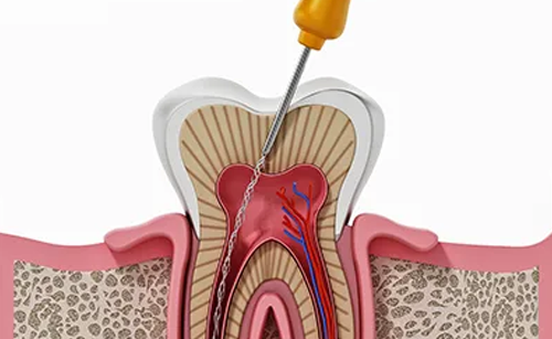 Root Canals