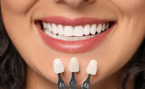 Porcelain Veneers