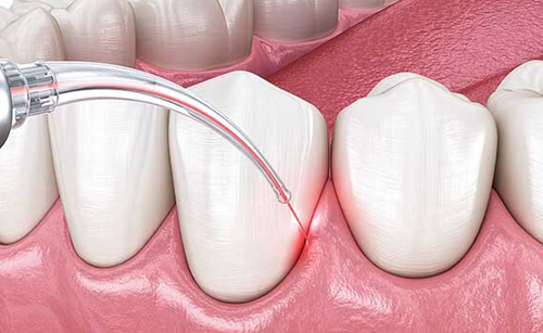 Gum Treatment
