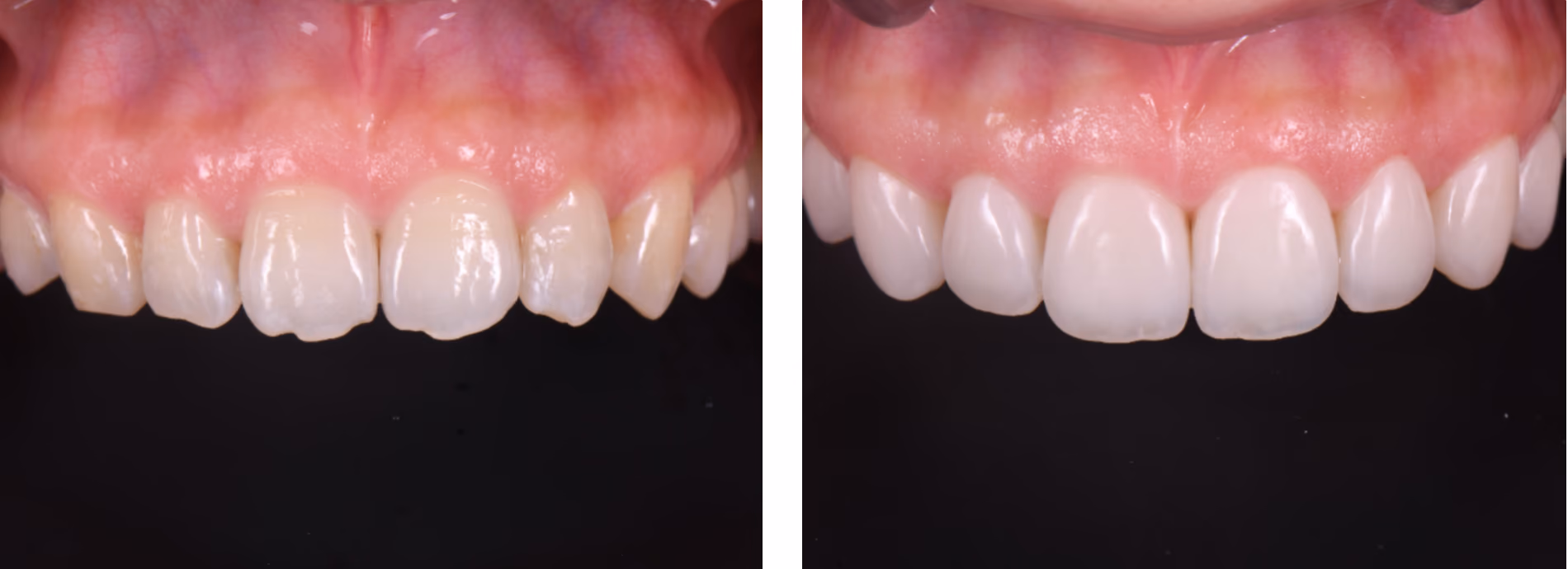 Prepless veneers smile refinement at City of Angels Dentistry, Downtown Los Angeles