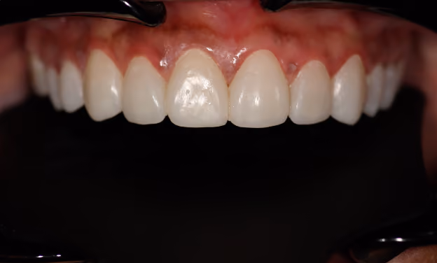 Close-up of the same patient's upper teeth after veneer treatment by Dr. Kevin Chin