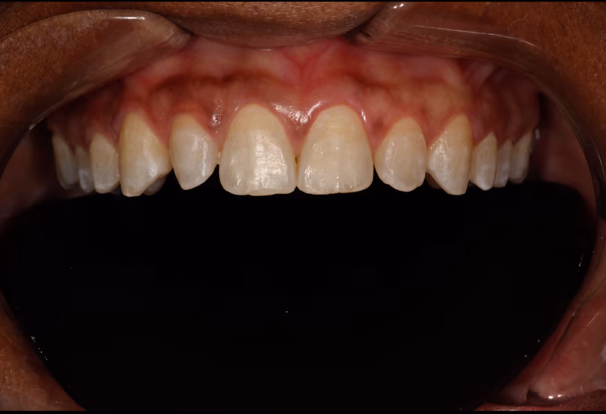 Close-up of the patient's upper teeth before veneer treatment