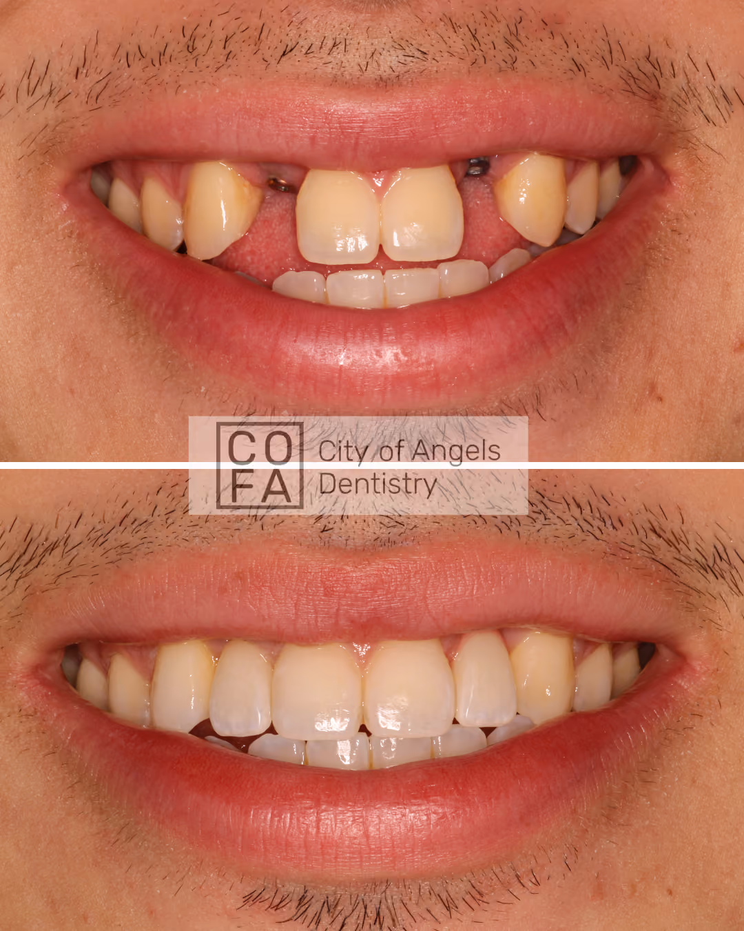 Diseño de sonrisa en City of Angels Dentistry
