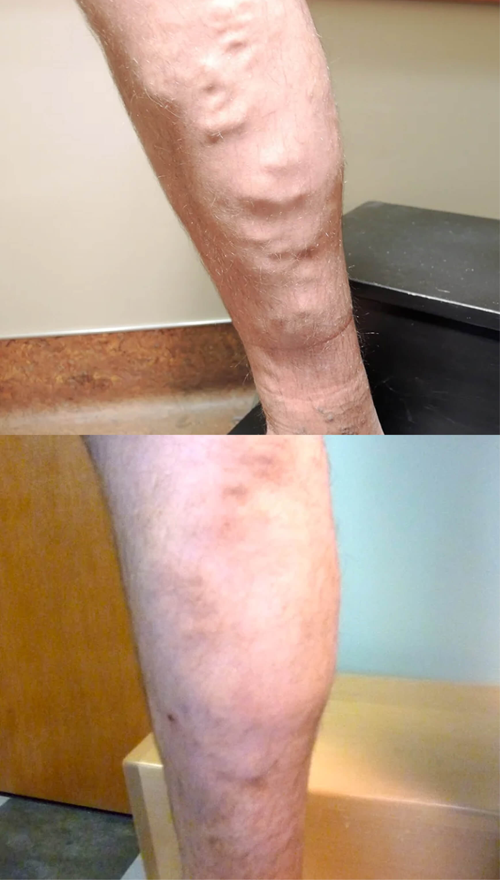 Before and after comparison of a leg treated for varicose veins