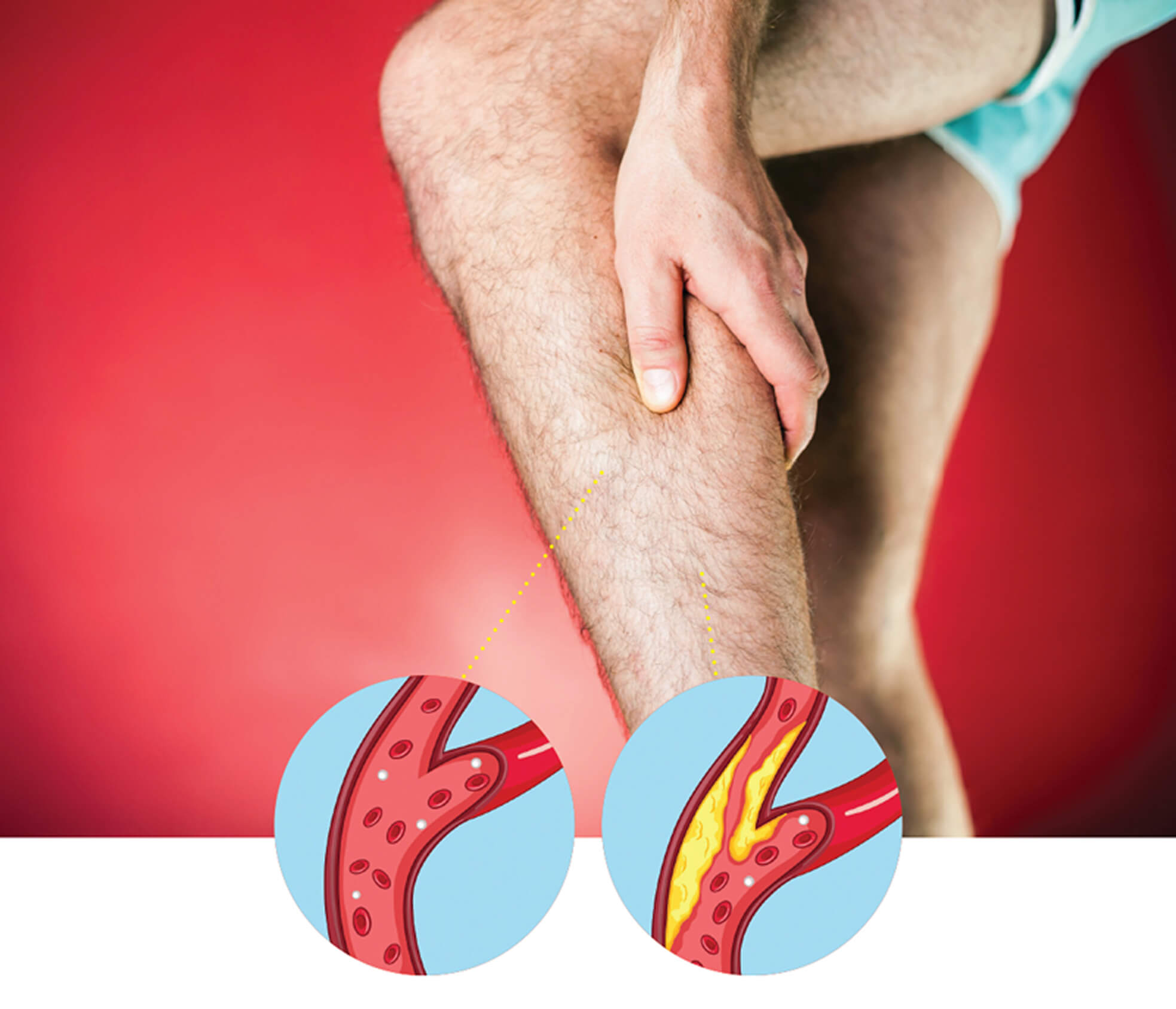 Medical diagram of peripheral artery disease in the leg