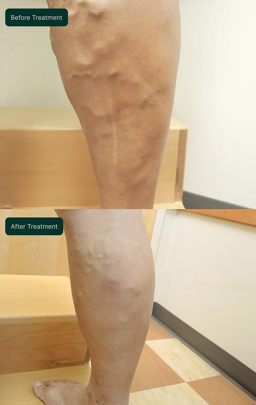 Before and after treatment comparison of a leg with varicose veins