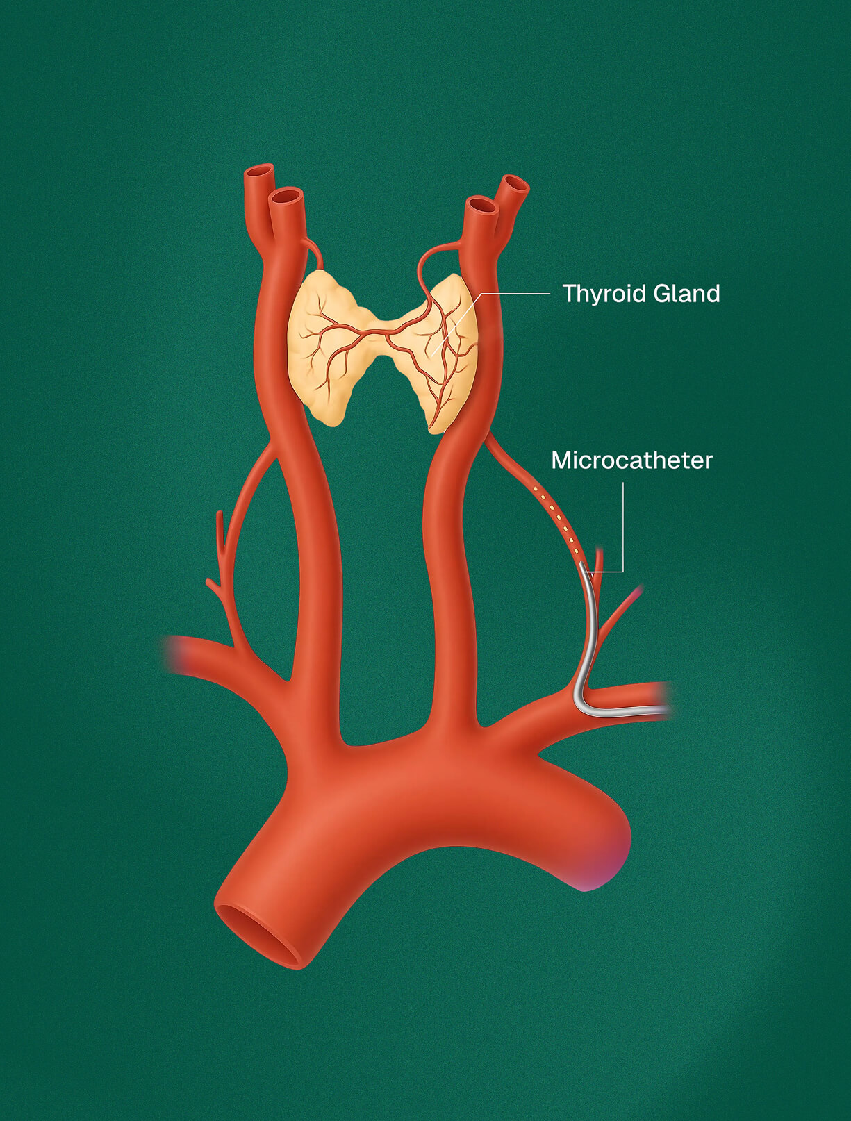 Diagram of thyroid artery embolization with a microcatheter reaching the thyroid gland