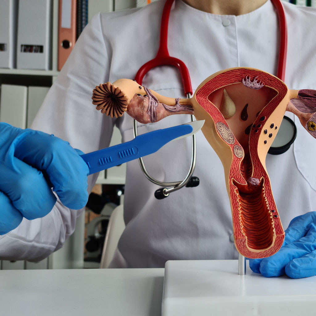 Anatomical model of a uterus used to explain hysterectomy alternatives