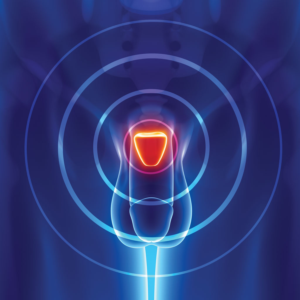 Illustration of an enlarged prostate, or benign prostatic hyperplasia