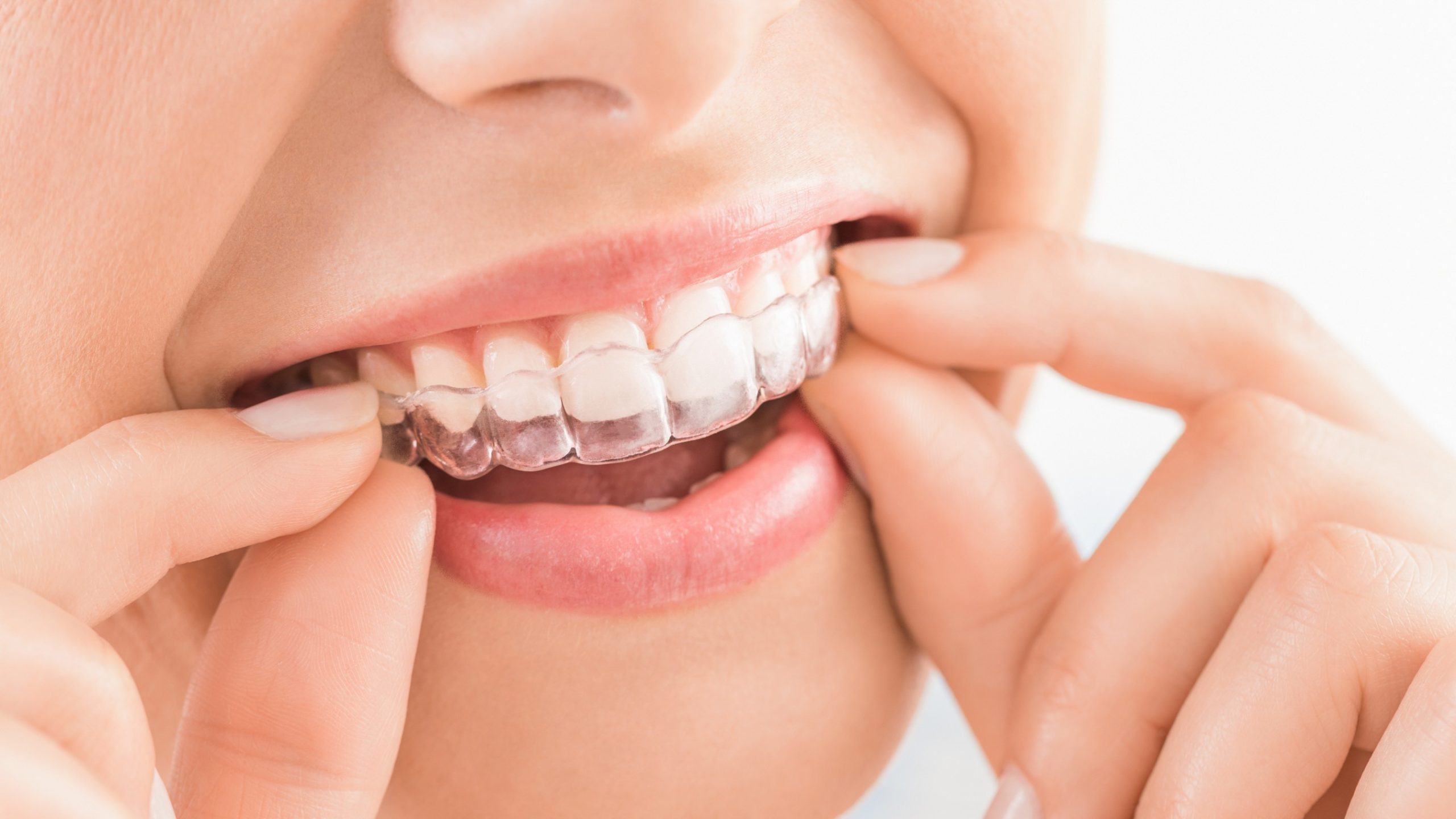Person placing a clear aligner over their teeth