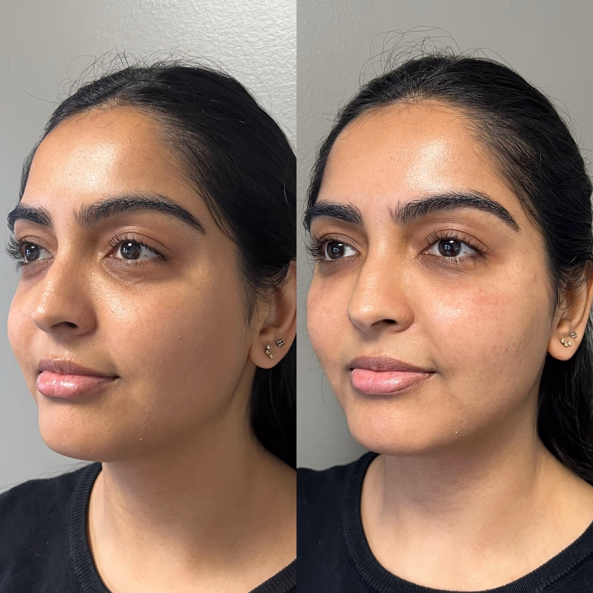 PRF EZ Gel · Before & After