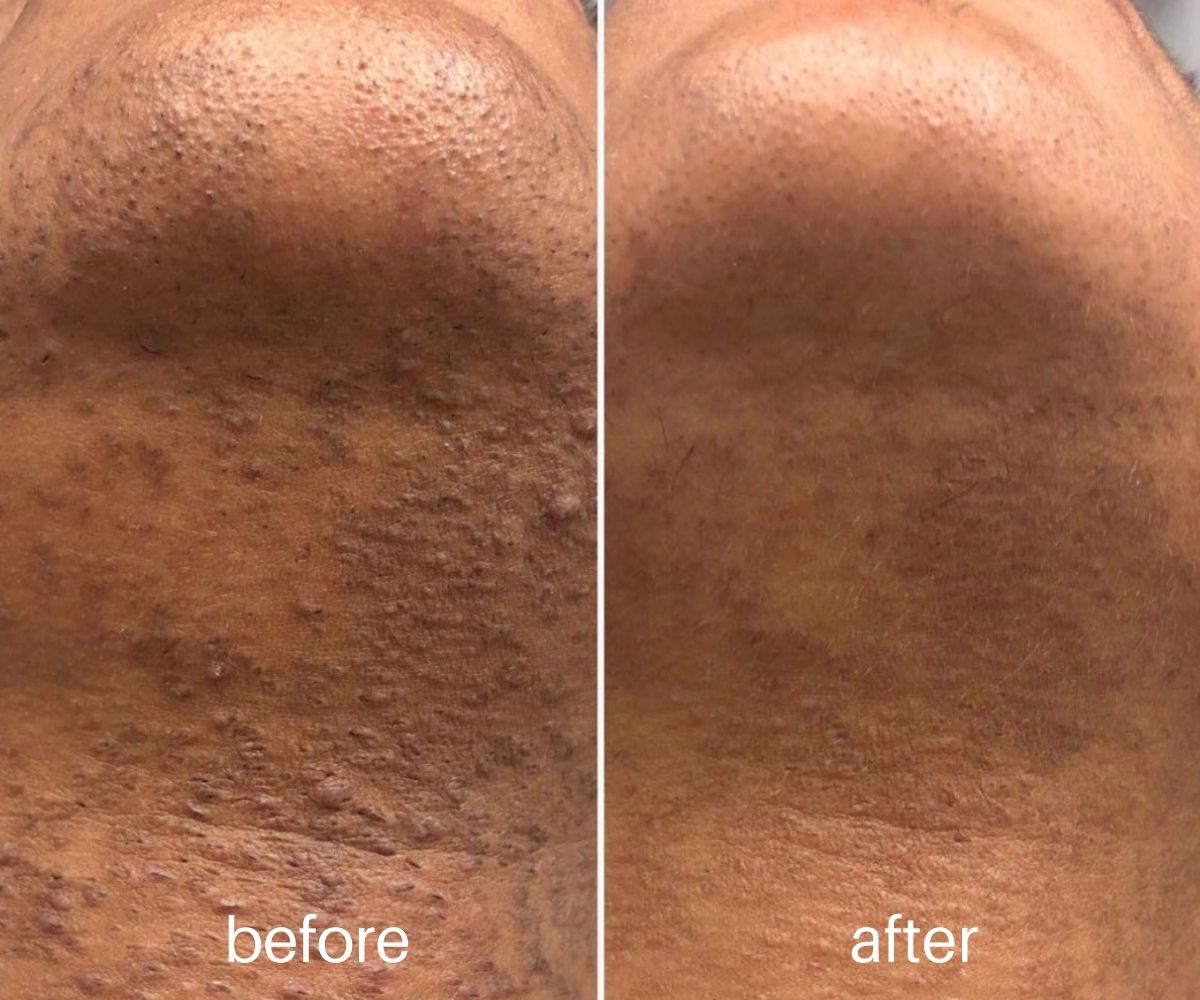 Laser Hair Removal · Before & After