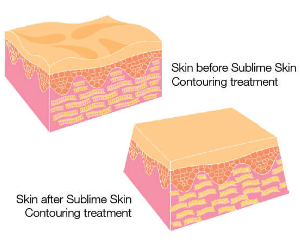 Sublime Skin Tightening treatment information