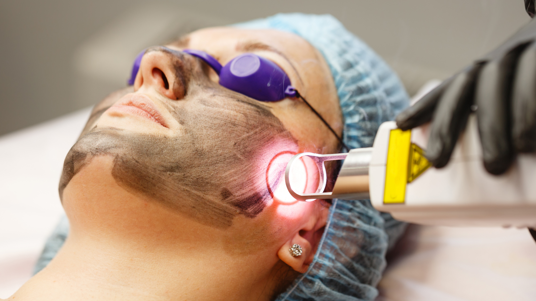 Hollywood peel facial, Hollywood laser facial near me