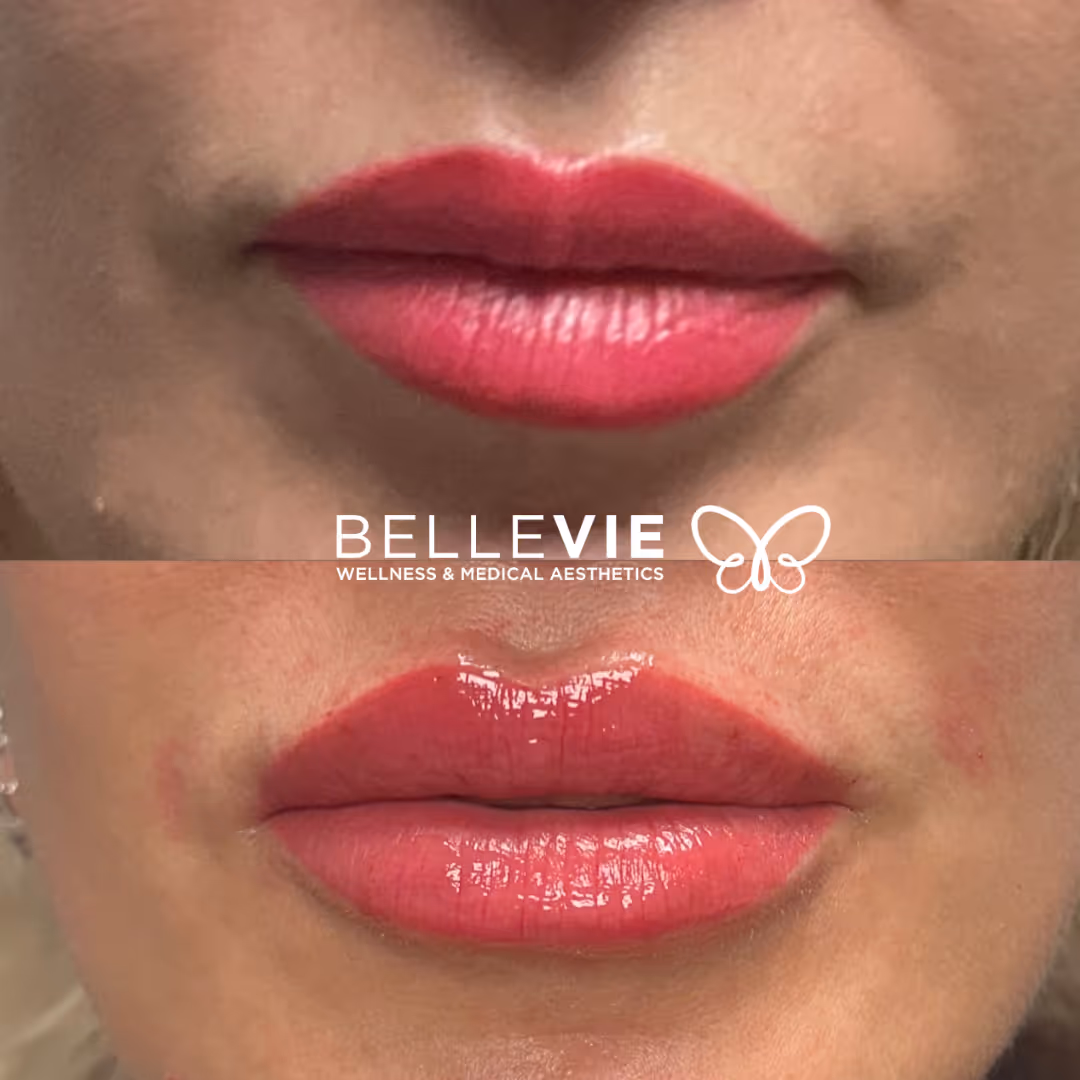 Before and after Dermal filler treatment from our published patient gallery