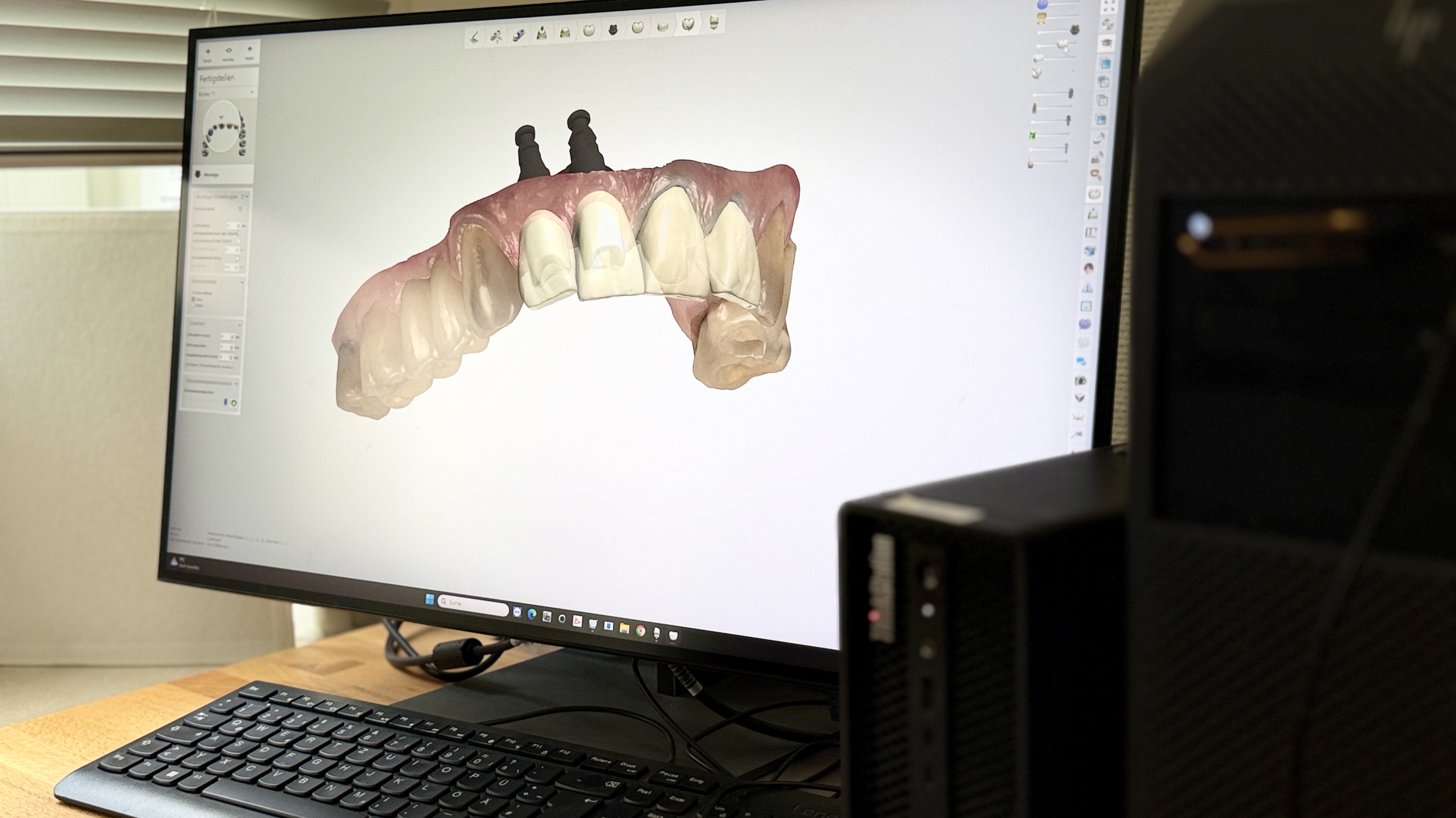 Digitale Konstruktion einer implantatgetragenen Vollkeramikbrücke im Meisterlabor