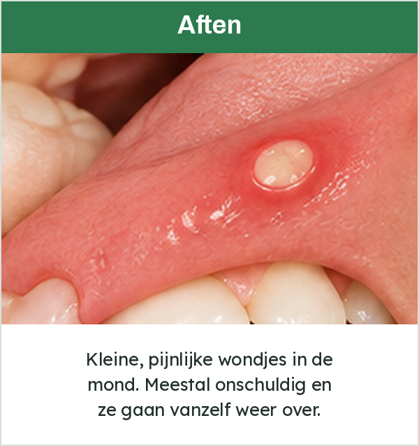 Een aft aan de binnenkant van de lip
