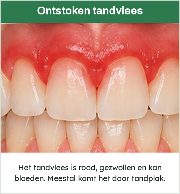 Rood en gezwollen tandvlees boven de voortanden